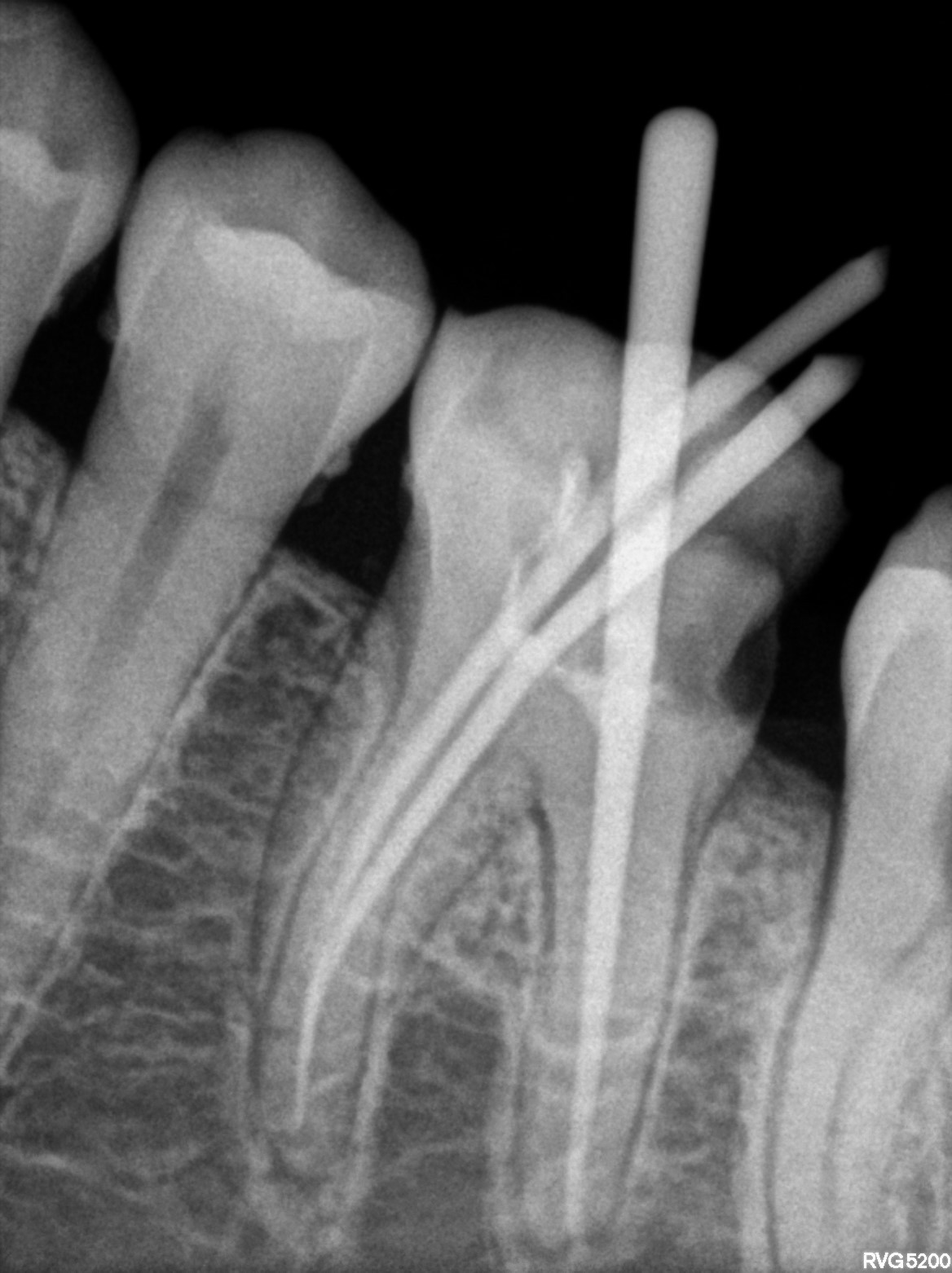 Dental X-ray